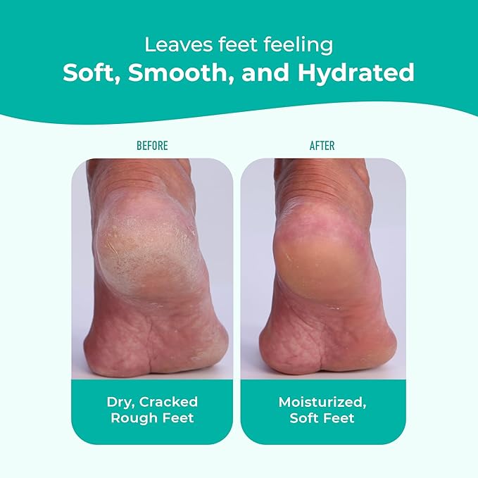 EZ Foot Care Cream - Advanced Exfoliating Urea Foot Cream for Dry Cracked Heels and Feet | 14 Natural Ingredients | Repairs, Hydrates and Smoothens Dry Cracked Feet - 100ml /3.38 fl. oz