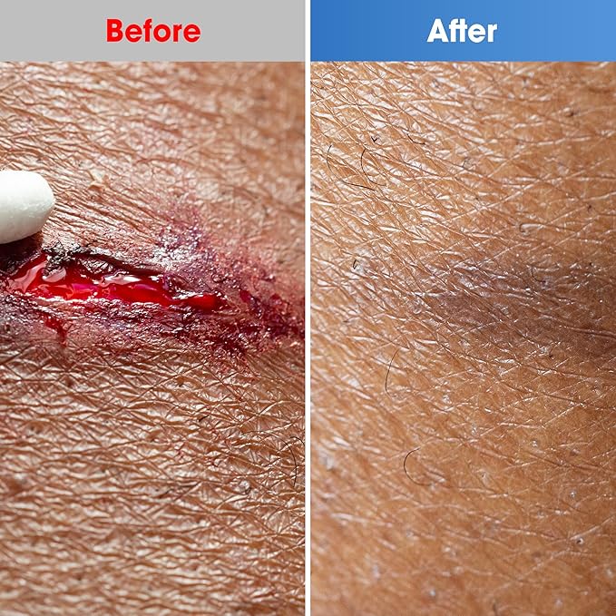 Hydrocolloid Bandages 2" x 4", 10 Pack Wound Dressing with Self-Adhesive, Fast Healing Patch for Bed Sore, Burn, Blister, Acne Care, Superficial Wound