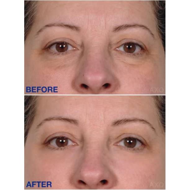 Age-Defying Under-Eye Serum | Best Instant Wrinkle Remover | Advanced Formula Anti Aging Visibly Reduces Under Eye Wrinkles, Bags, Dark Circles, Fine Lines & Crow’s Feet | 100% All-Natural