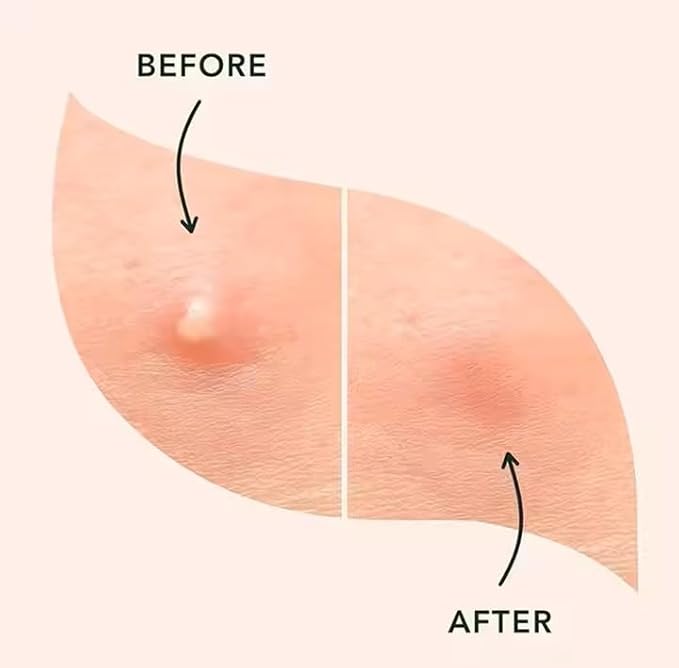 (5¢ Each) Pimple Patches 324 Pack - Hydrocolloid Acne Patches with Salicylic Acid & Tea Tree Oil - 4 Sizes S/M/L/XL - Face Acne Treatment - Easy Peel Perforated Sheets