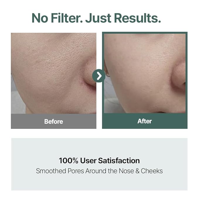 CELORABY Pore Recovery Bundle – 5-in-1 Glass Skin Device + Exosome Pore Serum for Deep Pore Care, Sebum Control, Enhanced Absorption, Korean Skincare at Home