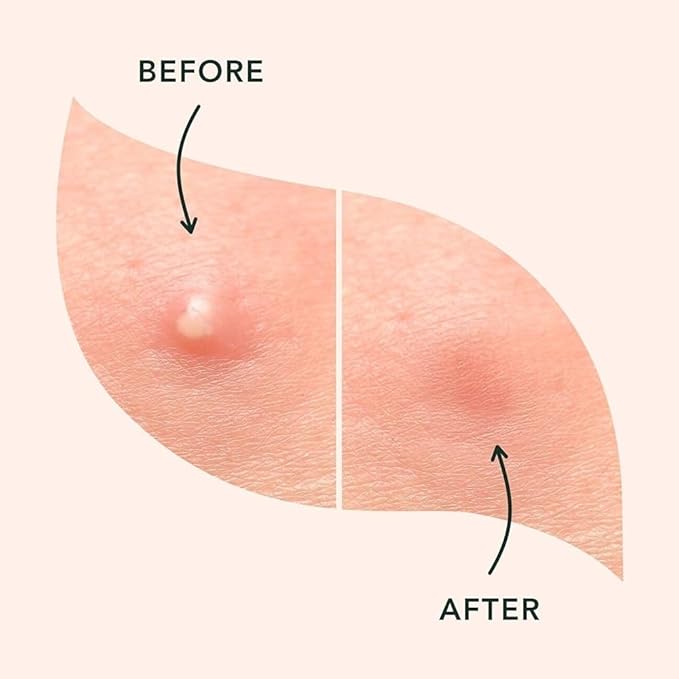 a.l.m. Magical Patch (2) Hydrocolloid pimple patches. These ultra thin & translucent hydrocolloid adhesive covers and absorb unwanted pimples. Parches Para Acne for skincare.