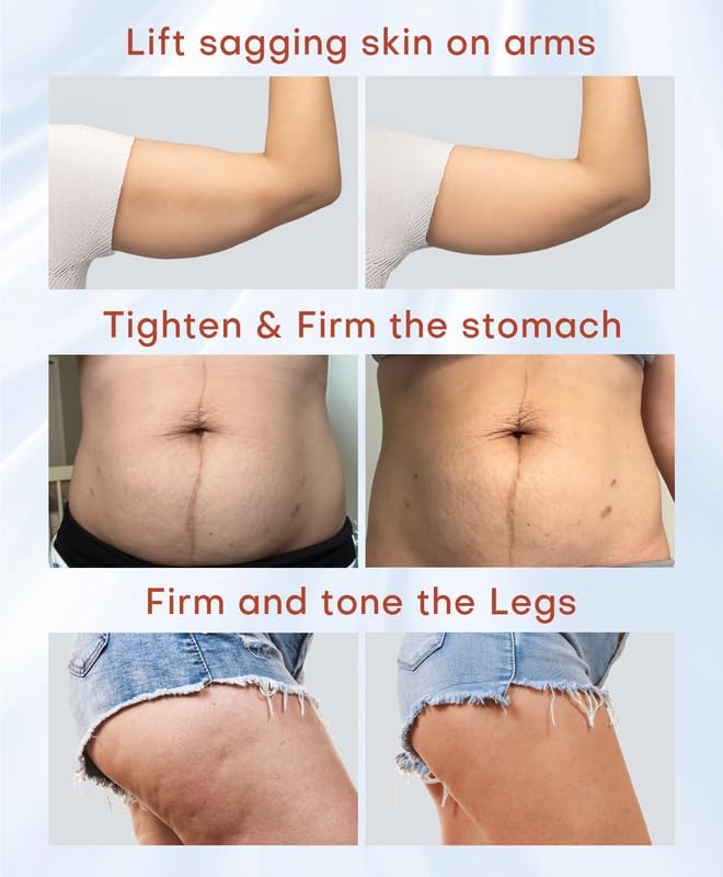 MLAY Professional RF Beauty Machine, Radio Frequency Face Machine with 2 Probes, at Home Radio Frequency Skin Tightening for Lifting, Wrinkle Reducing, Anti Aging - Salon Effects（Gel Included）