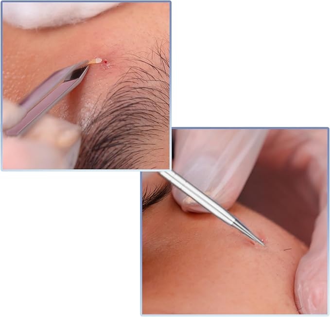 10 PCS Blackhead Remover Pimple Popper Tool Kit Blackhead Extractors Ingrown Hair Tweezers Pore Extractors Acne Treatment Tools for Clear Skin