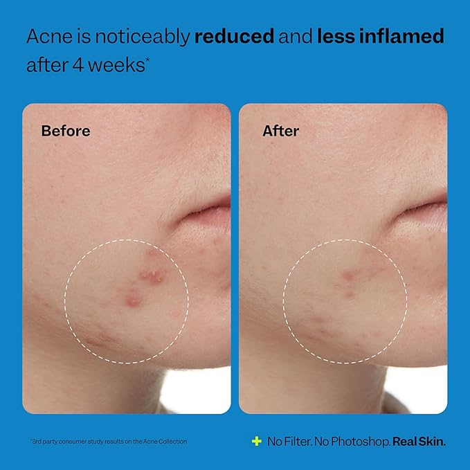 Peach Slices - 3-Step Acne Starter Kit (3 Products) - Skin Care Set - 1 Toner, 1 Cleanser, 1 Oil Free Moisturizer - 2% Salicylic Acid & Botanicals - Vegan & Cruelty Free - Korean Skin Care & Beauty