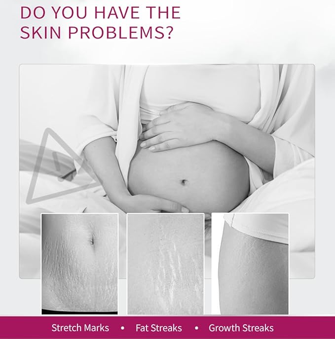 Stretch Mark Removal Cream, Obesity Stretch Mark Moisturizer, Postpartum Repair Stretch Mark Cream, Abdominal Stretch Mark Cream, Remove Marks (2 PCS)