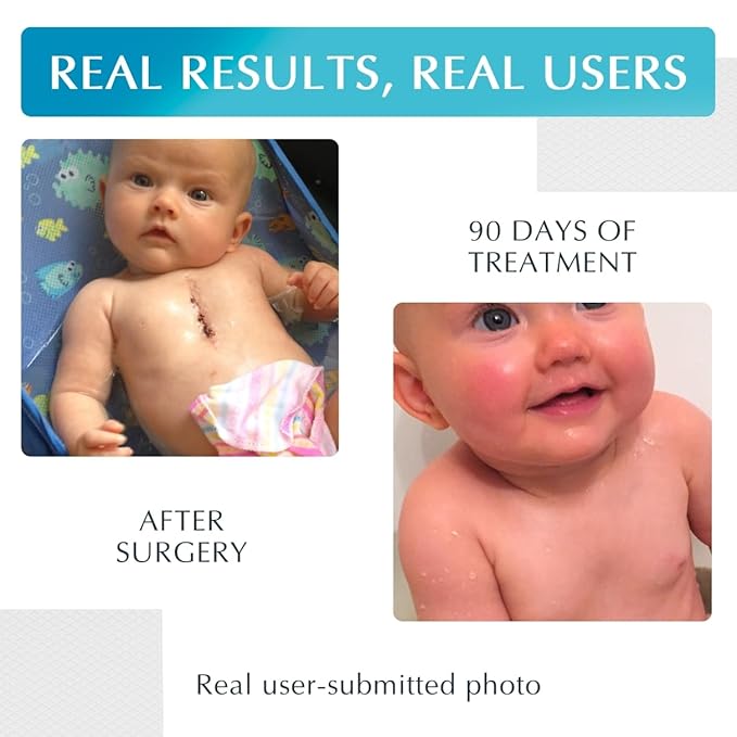 NewGel Plus by MyNewGel Day & Night Sun Defense Bundle, UV Scar Protection Gel for Day + Ultra Thick Silicone Sheeting (CLEAR) for Night, All Day Treatment