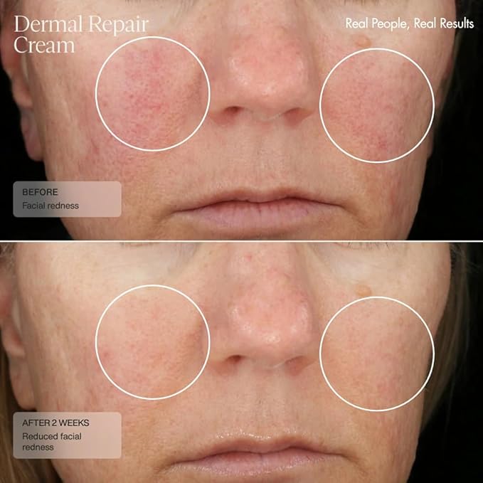 Senté Dermal Repair Facial Cream | Nourishing for Rosacea & Sensitive Skin | Hydrate & Rejuvenate | with Patented HSA, Vitamin E & Green Tea Extract - 1.7 Fl Oz