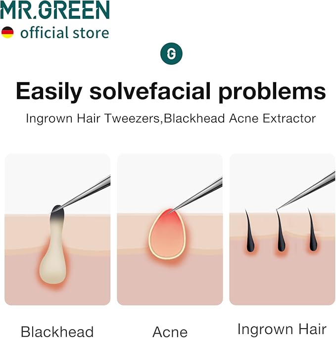 MR.GREEN Ingrown Hair Tweezers Needle Nose Pointed Tips Tweezers For Eyebrows Splinters Blackhead Removal Acne Clip Extractor (Short)