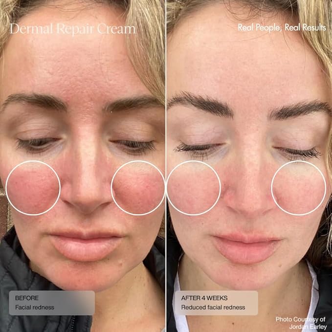 Senté Dermal Repair Facial Cream | Nourishing for Rosacea & Sensitive Skin | Hydrate & Rejuvenate | with Patented HSA, Vitamin E & Green Tea Extract - 1.7 Fl Oz