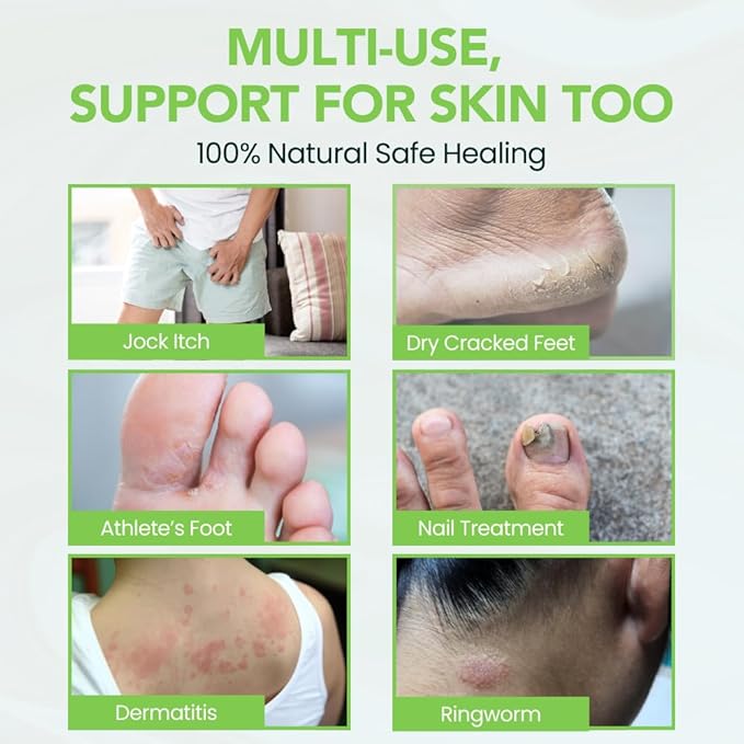 Thena Athlete’s Foot Cream Relieves Itching & Repairs Dry Cracked Feet & Heels, Extra-Strength Foot Balm with Tea Tree Peppermint Neem, Plant-based Treatment for Itchy Skin, Jock Itch, Ringworm