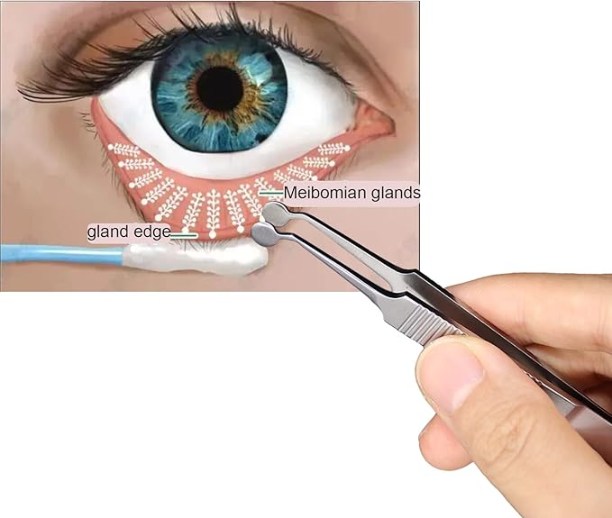 Meibomian Gland Expressor Stainless Steel Eyelid Massage Tweezers for Dryeye Extraction Tool