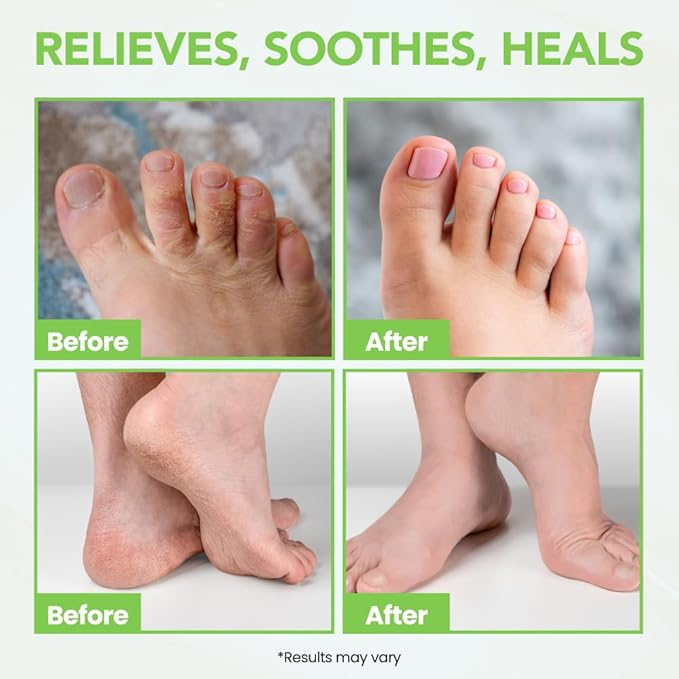 Thena Athlete’s Foot Cream Relieves Itching & Repairs Dry Cracked Feet & Heels, Extra-Strength Foot Balm with Tea Tree Peppermint Neem, Plant-based Treatment for Itchy Skin, Jock Itch, Ringworm