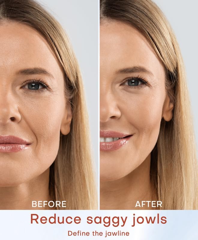 MLAY Professional RF Beauty Machine, Radio Frequency Face Machine with 2 Probes, at Home Radio Frequency Skin Tightening for Lifting, Wrinkle Reducing, Anti Aging - Salon Effects（Gel Included）