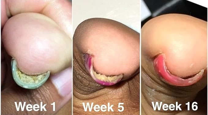 Probelle Natural Fungal Nail Oil,