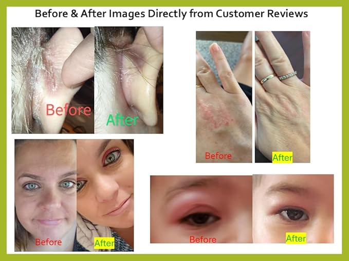 Tea Tree Oil Balm -100% All Natural | Great Cream for Soothing Irritations like Rashes, Insect Bites, Folliculitis, Acne, Itches, Dry Heels, Cuticles, Saddle Sores and more!