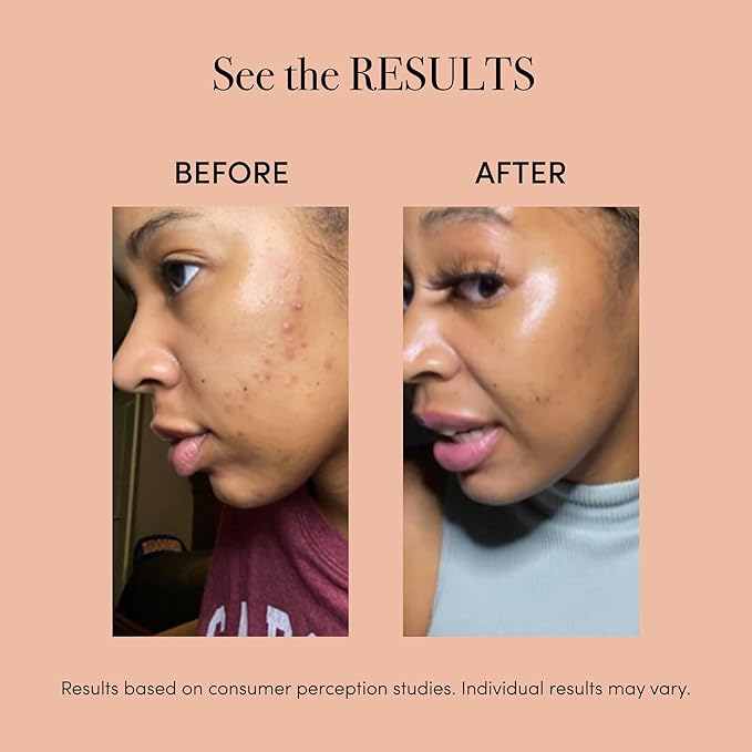 reVive Light Therapy Lux Collection Spot Acne Device, Portable Red & Blue Light LED Therapy Products for Blemish-Prone Skin, Rechargeable, On-The-Go Face Tools for Skincare, Black