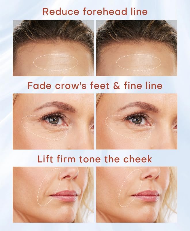 MLAY Professional RF Beauty Machine, Radio Frequency Face Machine with 2 Probes, at Home Radio Frequency Skin Tightening for Lifting, Wrinkle Reducing, Anti Aging - Salon Effects（Gel Included）