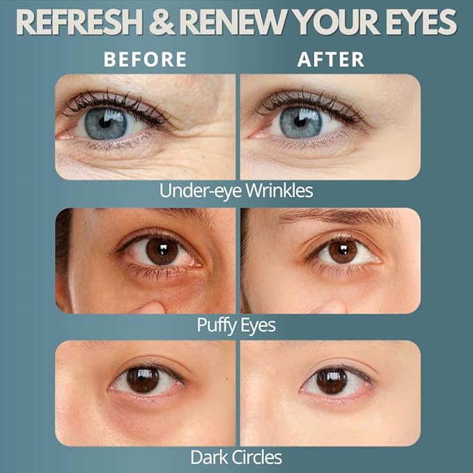 Under Eye Red Light Therapy, Rechargeable Eye Massager for Dark Circles Under Eye Bag Puffy Wrinkles Fine Lines