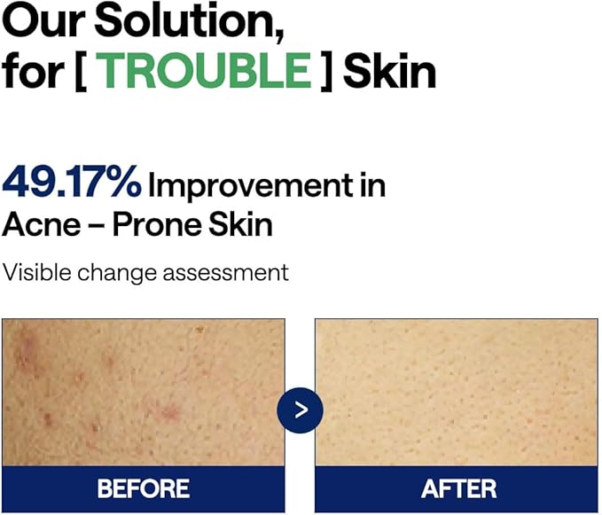 MEDIHEAL Toner Pads [Teatree] - Trouble Care Toner Pad with Teatree & Lactobacillus - Calming & Soothing for Sensitive & Acne Prone Skin - Vegan Hypoallergenic Face Gauze (100 Count)