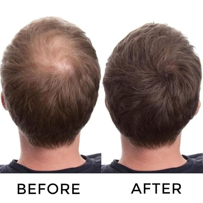 VOLLUCK Hair Fibers for Thinning Hair, Instant Coverage Hair Building Fibers for Women and men, Natural Hair Powder for Conceal Hair Loss 28 g*2 (Dark Brown, 2 PCS)