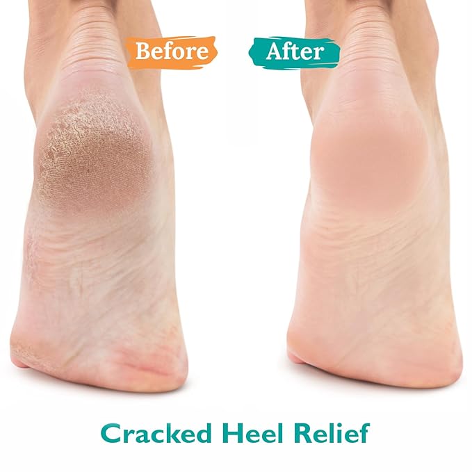 Urea Gel 42 Percent For Feet Maximum Strength Softens Cracked Heel Calluses & Thick Toenails