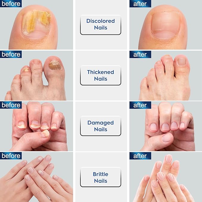 Toenail Fungus Treatment Extra Strength,