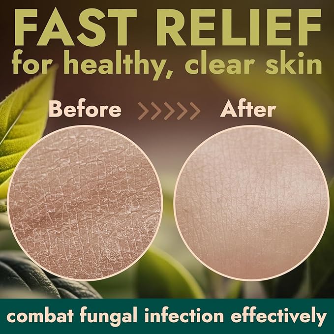 Antifungal Body Wash with Tea Tree Oil | Antibacterial Soap for Back Acne, Eczema & Jock Itch,Treats Ringworm | Antibacterial Body Soap For Men And Women (1% Tolnaftate Medicated Body Wash) 16.9 oz