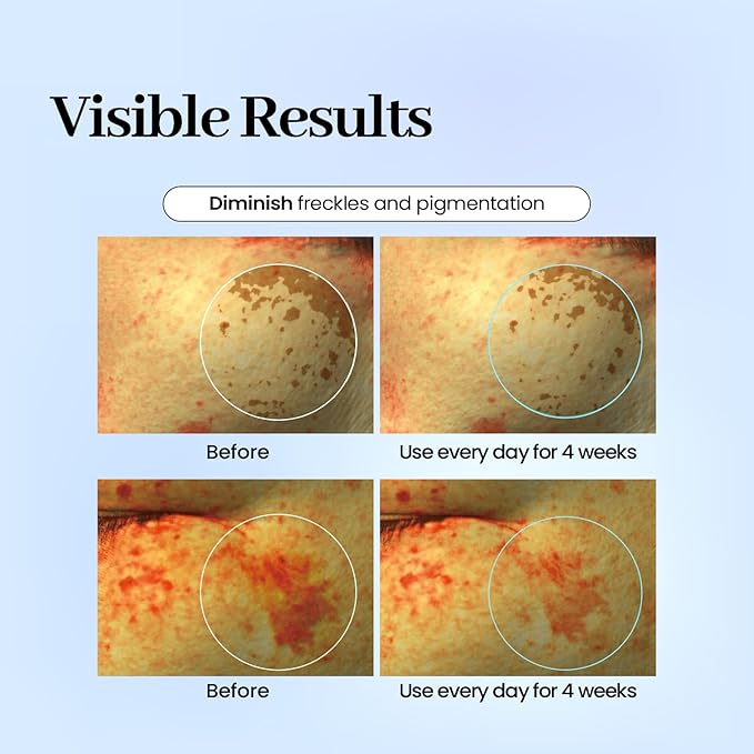 Dark Spot Care Patches – 32pcs | Labottach Korean Skincare Hydrogel Brightening Patch with Ozonated Olive Oil, Niacinamide, Alpha-Arbutin & PDRN | Skin Tone & Spot Care | Home Skin Routine