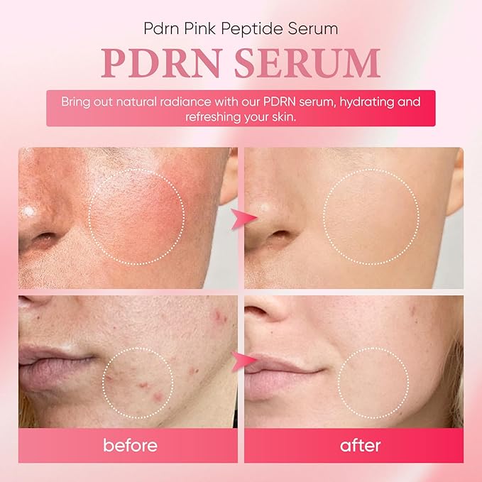 PDRN Serum, Pdrn Pink Peptide Serum, with Salmon DNA & Rose Combo Pack, Gentle Skincare for Radiance & Moisture, 30ml / 1.01 fl.oz