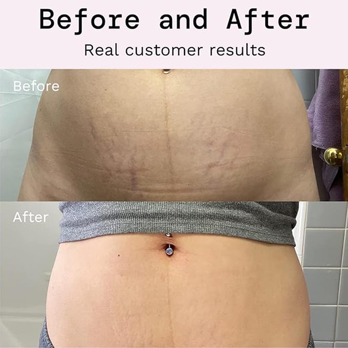 Stretch Mark Prevention Cream for Pregnancy, Stretch Mark Cream Remover, Stretch Mark Lotion for Pregnancy, Tummy Butter for Stretch Marks Pregnancy, Shea Butter Stretch Mark Removal Cream