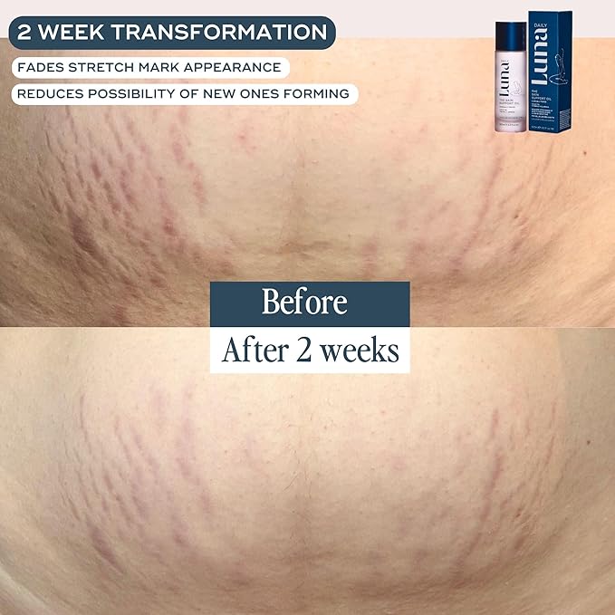 Luna Daily Stretch Mark Body Oil | Hydrating Treatment for Scars, Discoloration & Uneven Skin Texture | Vitamin C & Coconut Oil Nourish Dry Skin | Clinically Proven, Pregnancy Safe for Women, 300ml
