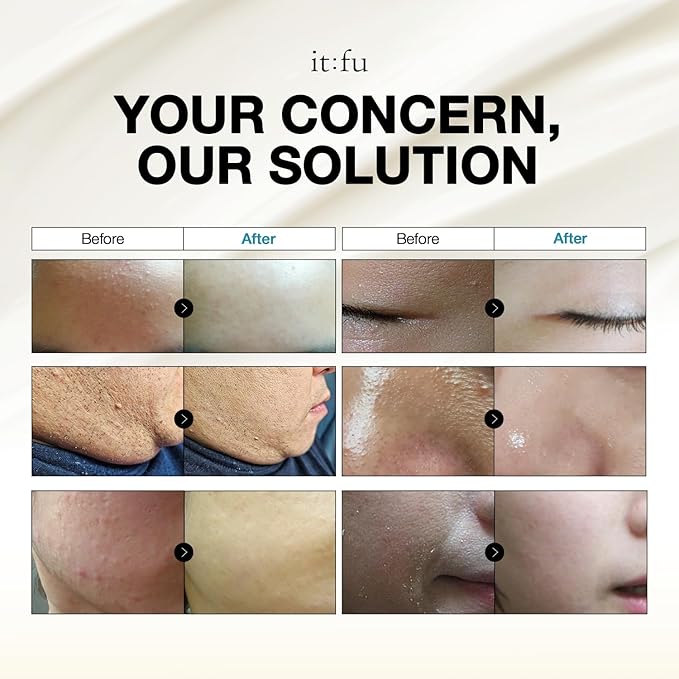 ITFU Repair Therapy Soonyuul Cream | Coix (Yulmu) Seed Grain, K-Beauty Moisturizer for Closed Comedone Acne, Whitehead Remover & Skin Barrier Repair, Acne Prone Skin Treatment, 1.69 fl. oz / 50ml