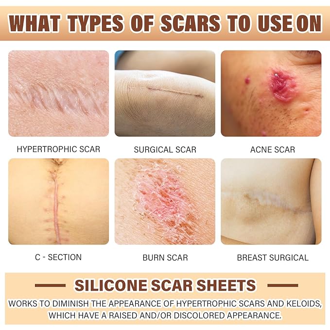 Silicone Scar Sheets,Silicone Scar Tape,Silicone Sheets