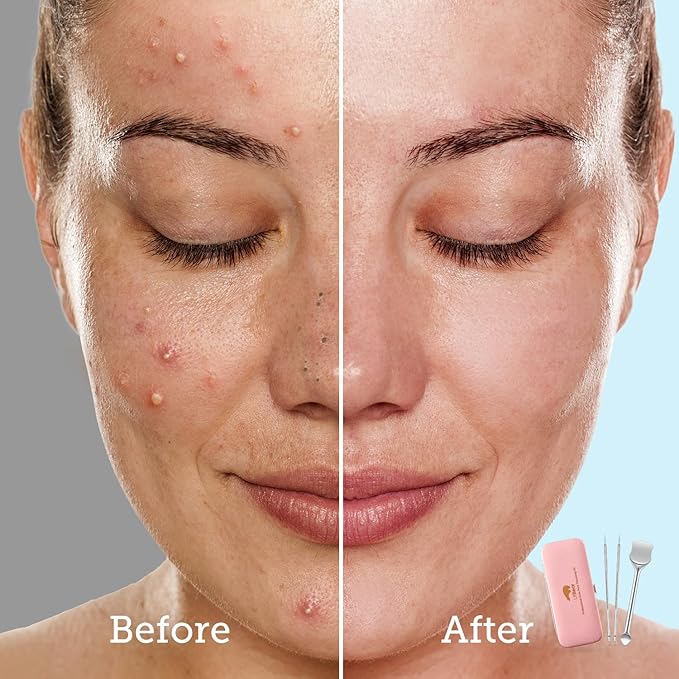 LitBear Pore Prep Tool, Blackhead Remover Pimple Popper Tool Kit, Stainless Steel Blackhead Extractions Tool for Acne, Whitehead Popping, Blemish, Comedone, Pink