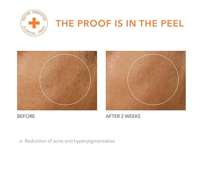 Dr. Dennis Gross Alpha Beta Universal Daily Peel: for Uneven Tone or Texture and Fine Lines or Enlarged Pores, (5 Treatments)