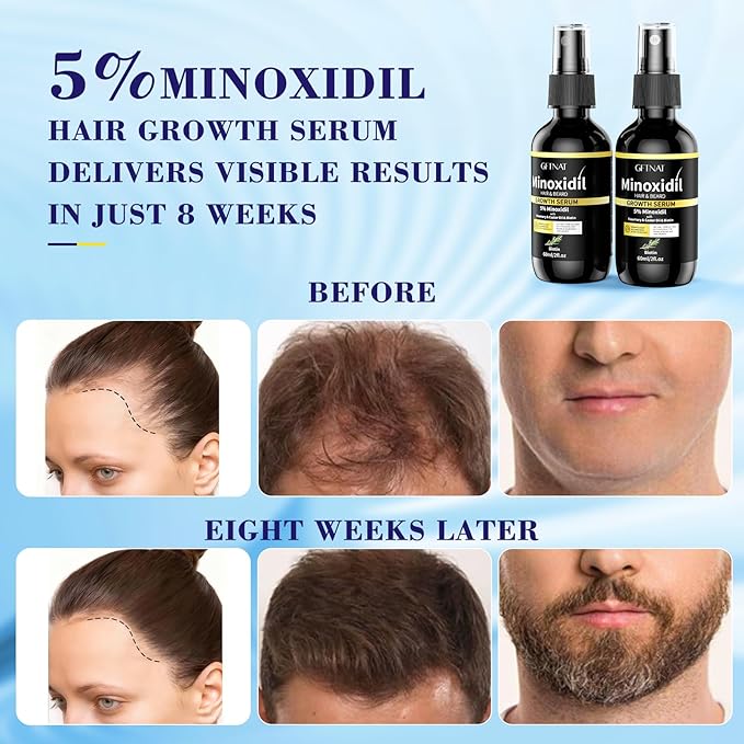 5% Minoxidil for Women with Biotin and Rosemary Hair Growth Serum (Glass Bottle), 5% Minoxidil for Men Spray for Thicker Fuller Hair