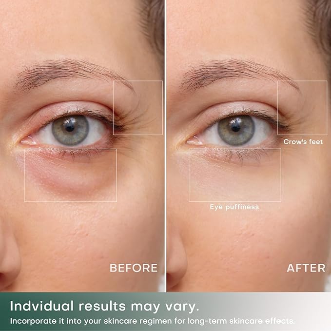 RF Eye Device | 2 in 1 Professional Eye Skin Care Pencil | Under Eye Bags Treatment | Eye Bags | Eye Puffiness | Fine Line | Wrinkle Reducing | RF Radio Frequency Anti Aging Device(with Gel)