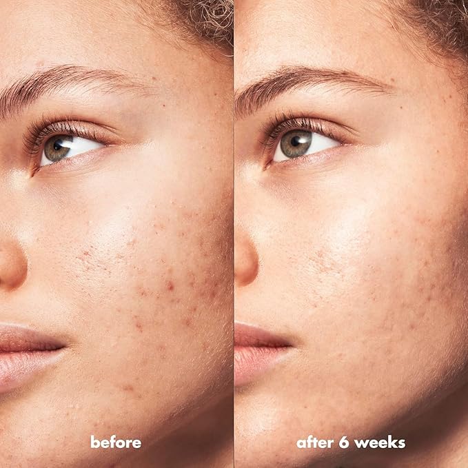 e.l.f. SKIN Blemish Breakthrough Calming Water Cream Mini, Lightweight Blemish-Fighting Face Moisturizer, Prevents New Blemishes & Calms Skin