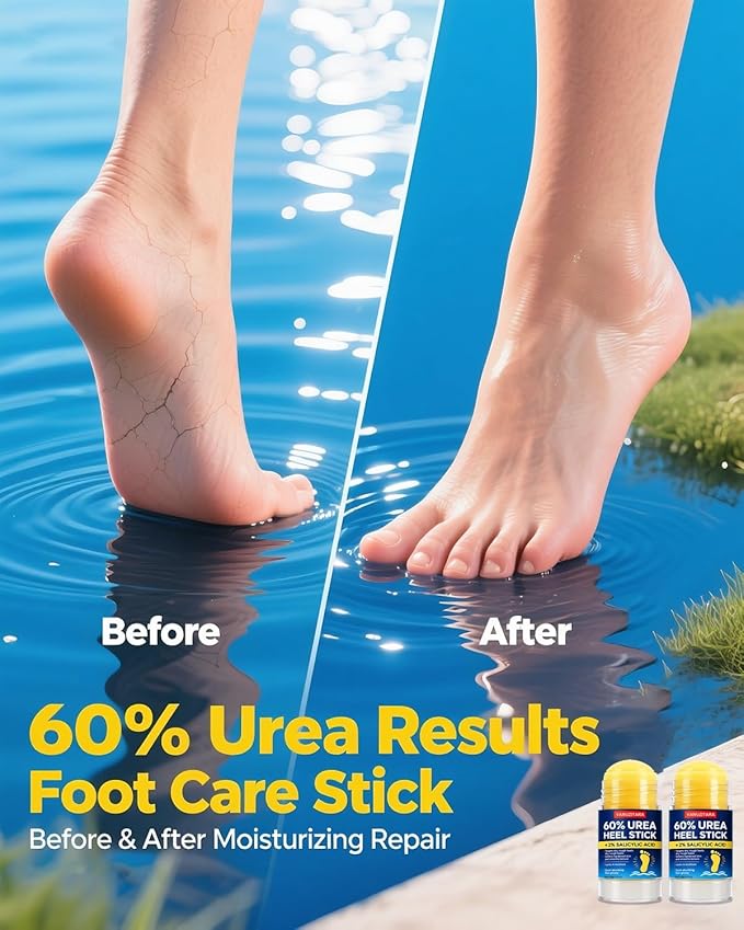 Urea Cream 60 Percent with 2% Salicylic Acid, Maximum Strength Foot Cream for Rough, Dry Cracked Feet Hands and Elbows, Urea Stick Callus Remover Skin Softener Hydrating Balm 2 Pack (1.41oz Each)