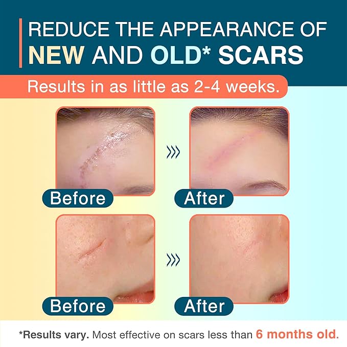 Silicone Scar Sheets, 1.5¡± x 156¡±