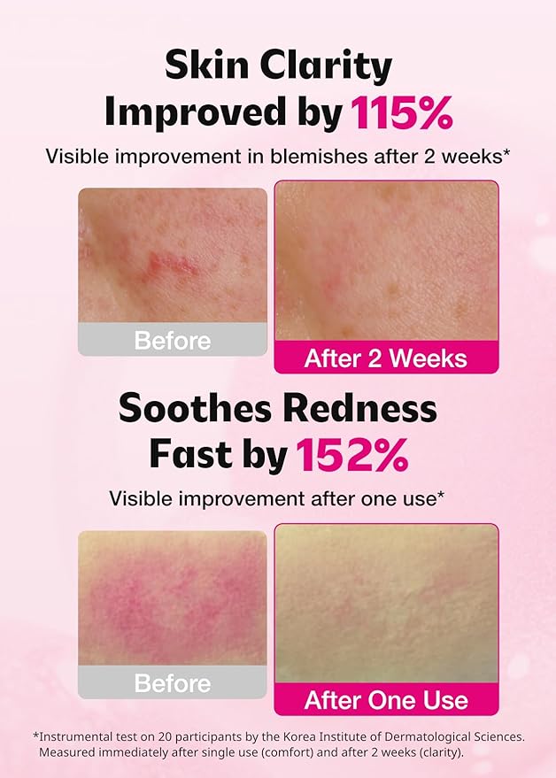 ISOI Blemish Care Up Serum for Face, Vegan Hydrating Serum for Smooth & Glass Skin Effect, Skin Barrier & Moisture Balance for Women, Arbutin & Rose Otto Oil, Korean Skin Care (0.85 fl. oz, 25ml)