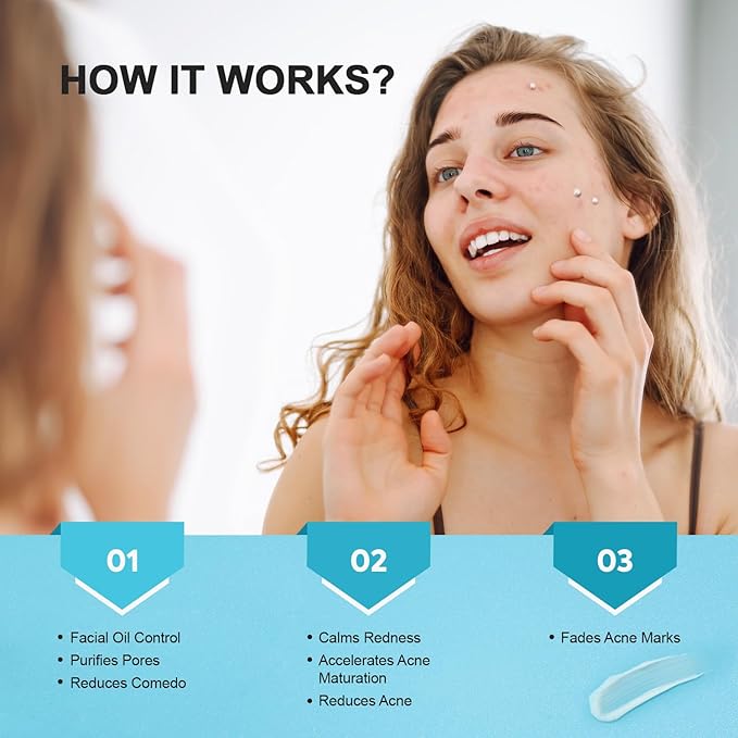 Acne Pimple Spot Treatment Cream: Cystic Hormonal Blackheads Blemish Remover for Face, Back and Body - with 10% Azelaic Acid - Teens 13-19 & Young Adult 20-30, 1.8 oz