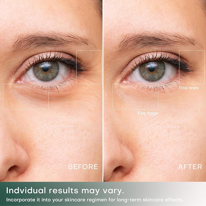 RF Eye Device | 2 in 1 Professional Eye Skin Care Pencil | Under Eye Bags Treatment | Eye Bags | Eye Puffiness | Fine Line | Wrinkle Reducing | RF Radio Frequency Anti Aging Device(with Gel)