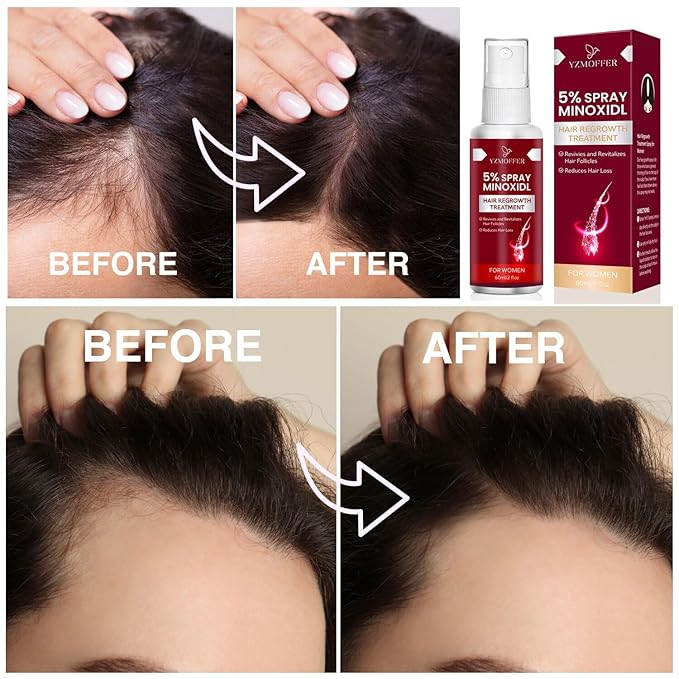 5% Minoxidil Spray for Women Hair Growth: Hair Regrowth Treatment for Thinning Hair and Hair Loss – Topical Hair Growth Serum for Women – 60ML x 2 Pack