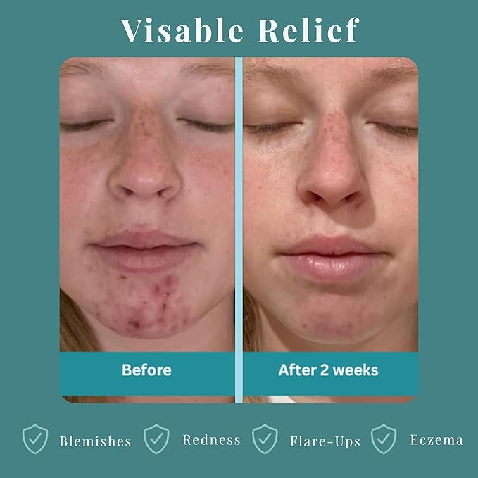 JusSpray™ Hypochlorous Acid (HOCl) Spray – Doctor Approved Skin Defense Mist 4 oz – Face & Body Toner for Sensitive, Acne & Eczema-Prone Skin, Redness Relief & Piercing Aftercare