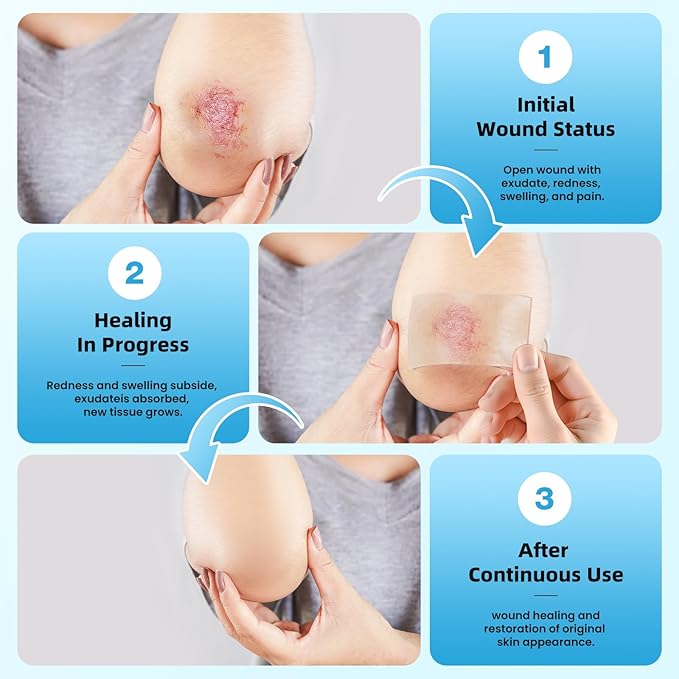 Hydrocolloid Roll for Wound Care, 2in x 5ft Extra Large Hydrocolloid Bandages with Self-Adhesive, Cut-to-Size, Ultra Absorbent, Flexible & Waterproof for Burn, Blister, Acne Care