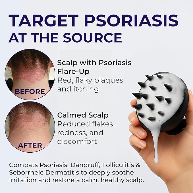 Scalp Psoriasis Shampoo, Flakes Shampoo Anti Dandruff, Itchy Scalp Treatment for Seborrheic Dermatitis & Folliculitis, Anti Fungal, Medicated Solution for Itchy, Flaky & Dry Hairs