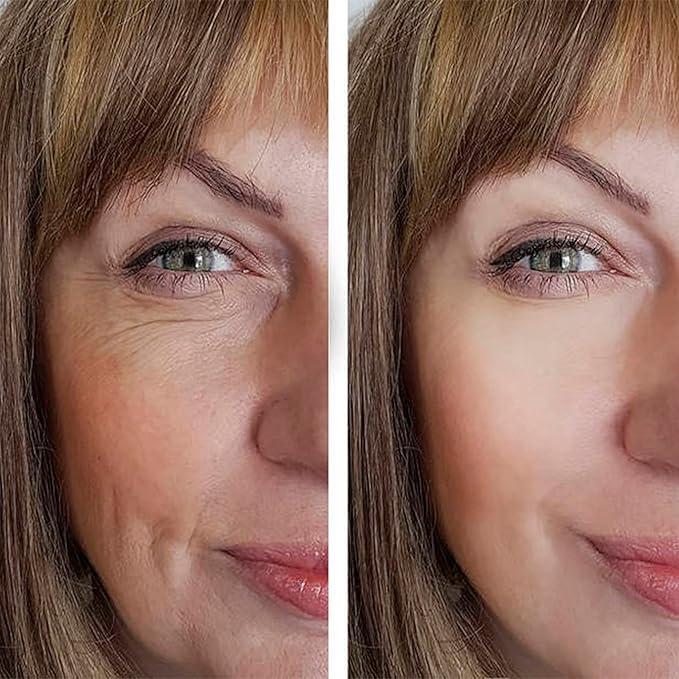 Pdo Lifting Thread, Pdo Threads Lift for Eyes, Helps Restore Skin's Firmness and Elasticity, and Improves Eye Wrinkles (20PCS-30G*25MM)