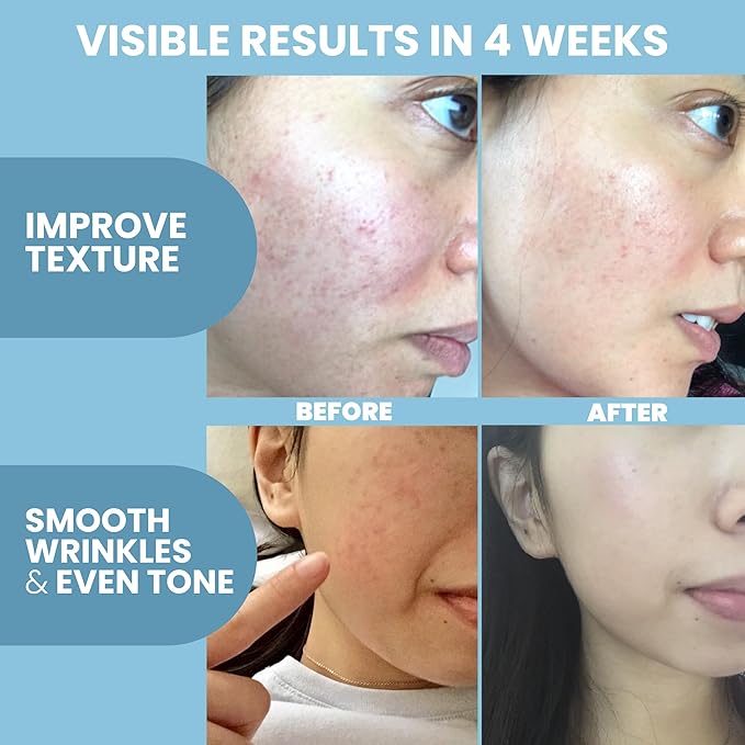 Eva Naturals Peptide Complex Serum + Microneedle Derma Roller - 0.25mm Titanium Derma Tool for Face & Scalp with Peptide Facial Serum & Derma Roller Bundle